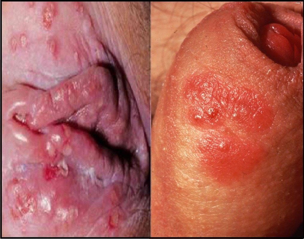 Genital herpes frau - 🧡 Candida grybelis gydant vyrus Onycosolve.